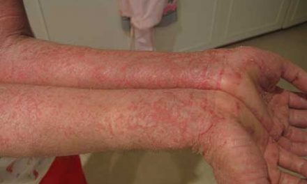 Qué diferencia hay entre eczema y dermatitis atópica