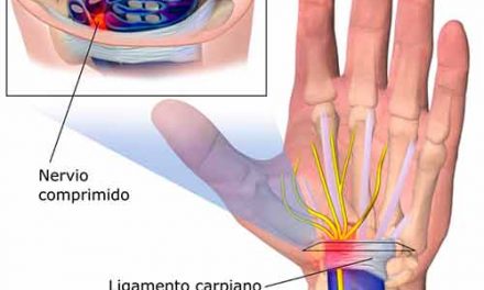 Qué diferencia hay entre la artritis y el túnel carpiano