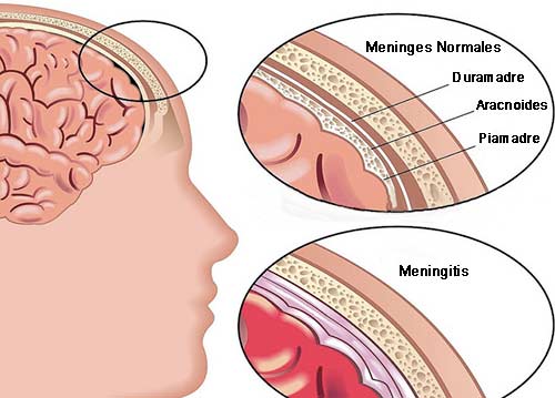 Meninges normales y con meningitis