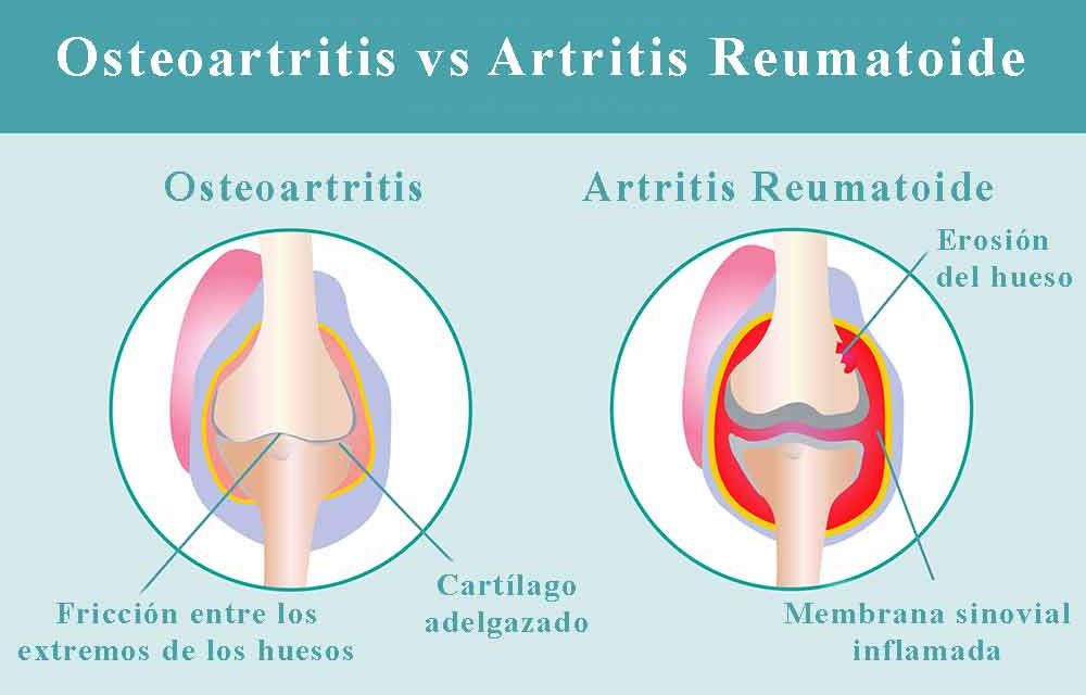 Qué diferencia hay entre osteoartritis y artritis reumatoide