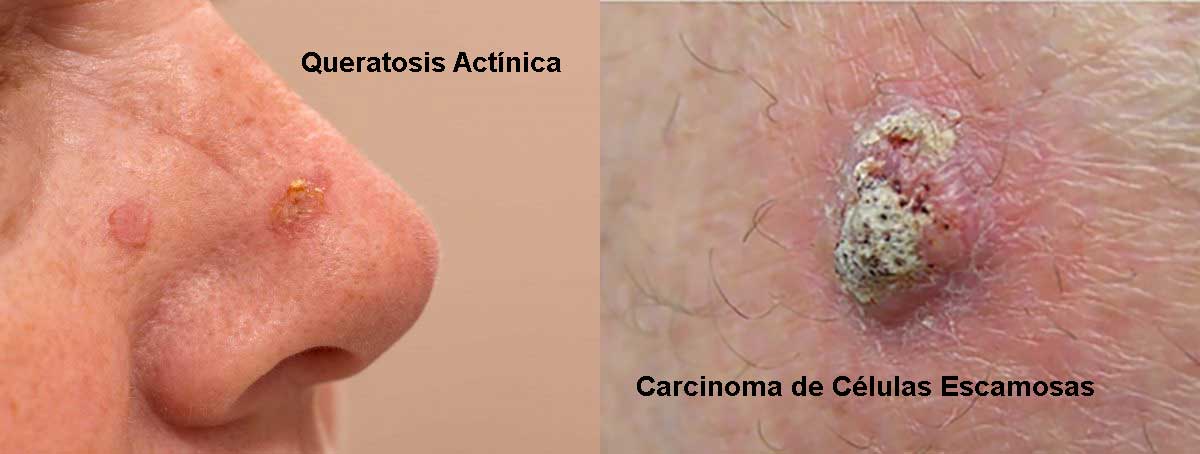 Qué diferencia hay entre queratosis actínica y carcinoma de células escamosas