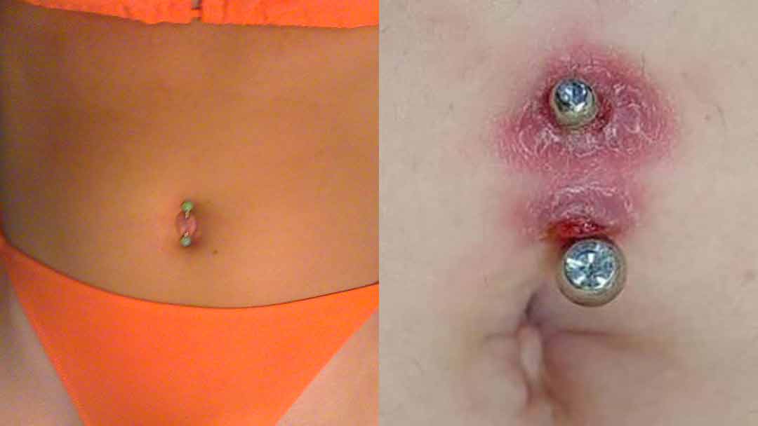 Qué diferencia hay entre un piercing de ombligo infectado y uno que ya se curó